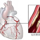 冠狀動脈疾病（包括冠心病）