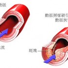 高血脂症