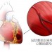 心臟病發作