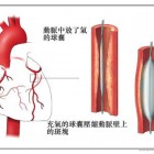 冠狀動脈氣球擴張術