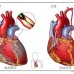 冠狀動脈旁路移植手術（搭橋手術）